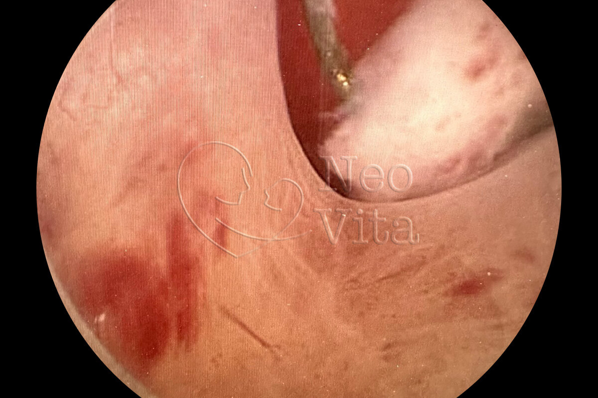 histeroscopia cirurgica histeroscopia diagnostica